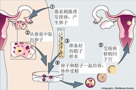 卵巢评估